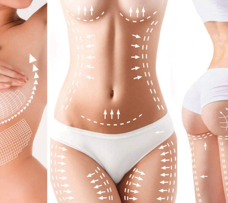 Body contouring procedures after pregnancy and childbirth